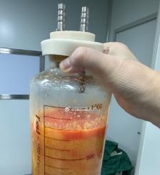 张掖水动力吸脂手术要做多久？